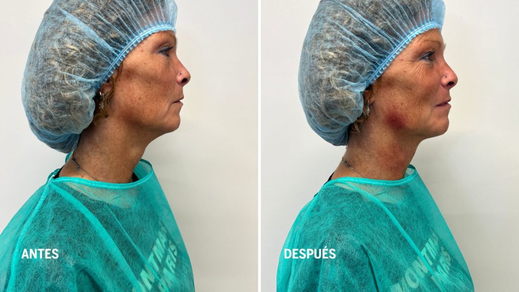 mesoterapia-cuello-tratamientos-de-rejuvenecimiento-facial-realizados-por-enfermeras-dermoesteticas