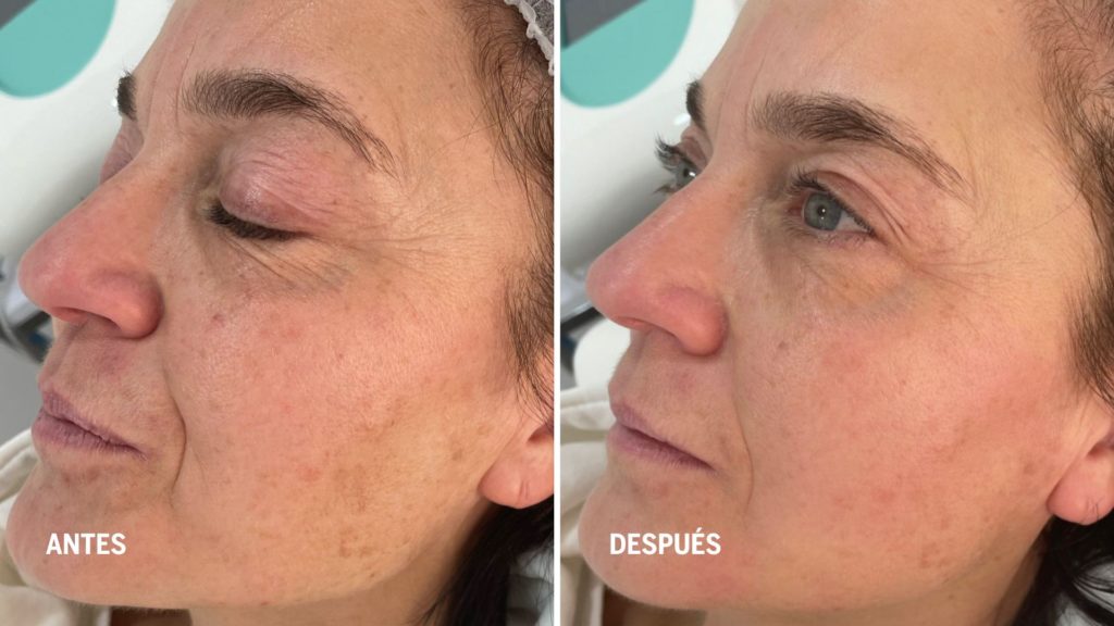 peeling quimico-tratamientos-de-rejuvenecimiento-facial-realizados-por-enfermera-dermoesteticas