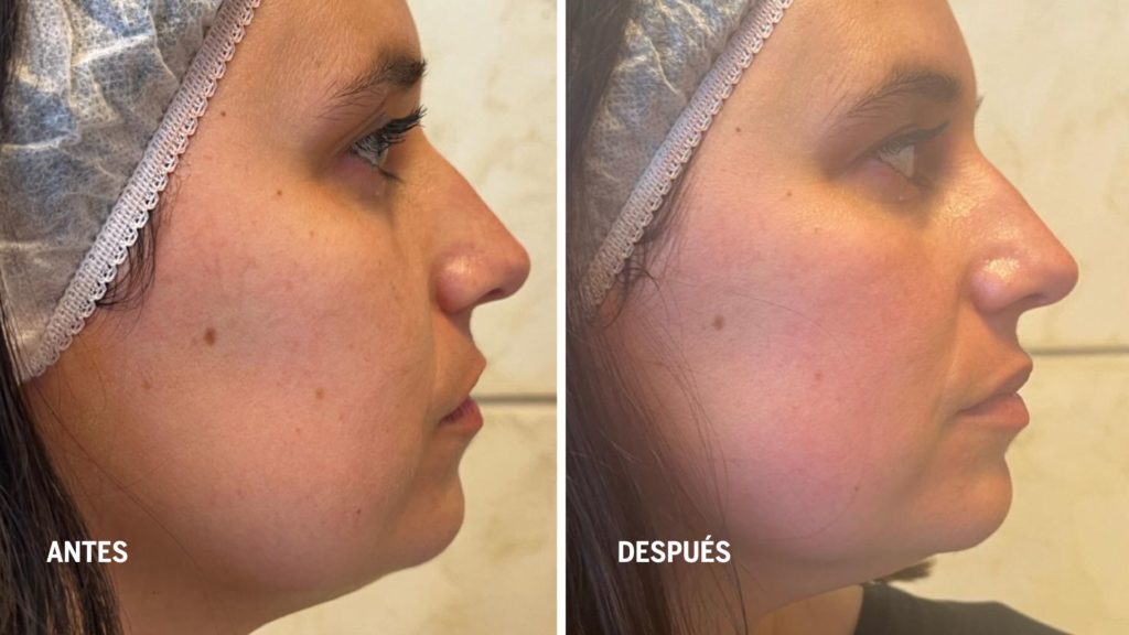 radiofrecuencia-tecarterapia-tratamientos-de-rejuvenecimiento-facial-realizados-por-enfermeras-dermoesteticas