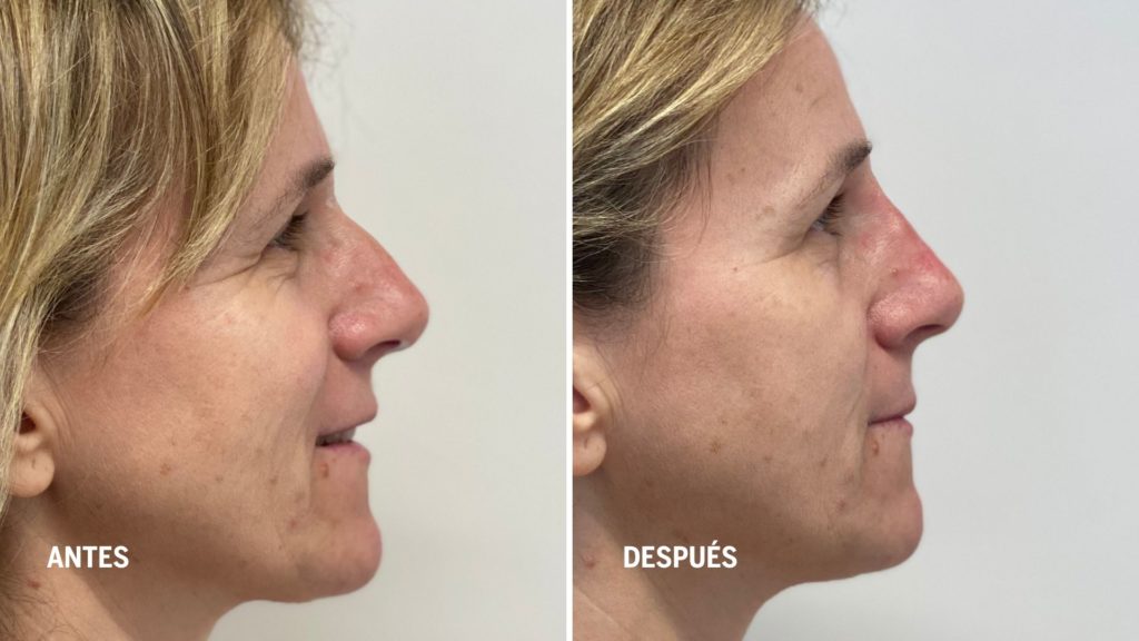 rinomodelacion-tratamientos-de-rejuvenecimiento-facial-realizados-por-enfermeras-dermoesteticas