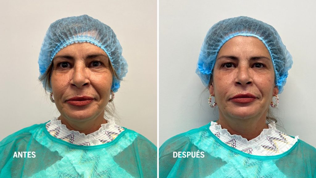 tecnica-de-4-puntos-tratamientos-de-rejuvenecimiento-facial-realizados-por-enfermeras.dermoesteticas