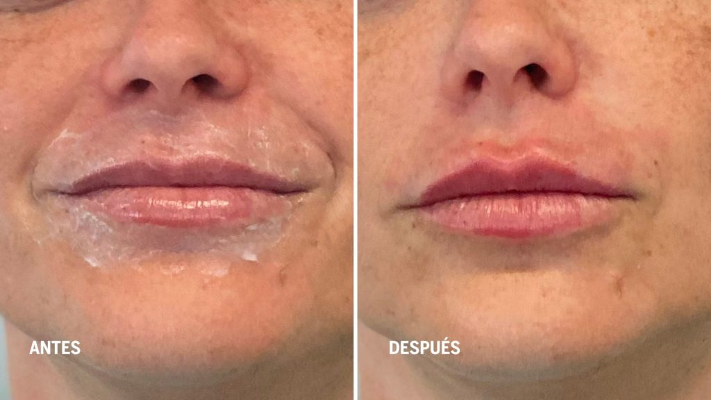 tecnica-de-labios-tratamientos-de-rejuvenecimiento-facial-realizados-por-enfermeras