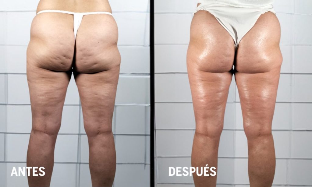 antes-y-despues-en fisioterapia-dermatofuncional tratamiento-para-paniculopatia-edemato-fibroesclerotica