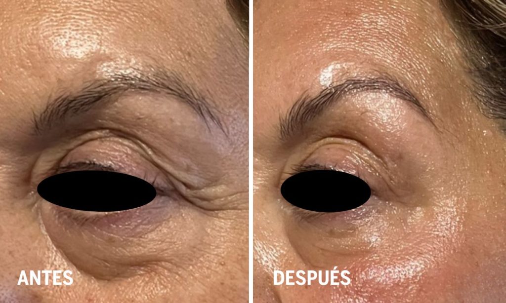 tratamiento-contorno-ocular-antes-y-despues-en fisioterapia-dermatofuncional
