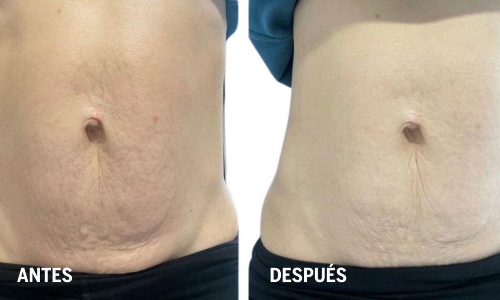 tratamiento-para-flacidez-abdominal-postparto-antes-y-despues-en fisioterapia-dermatofuncional
