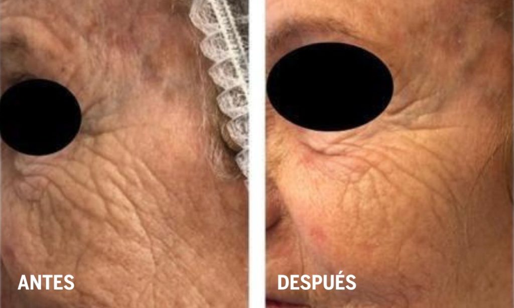 tratamiento-para-la-flacidez-cutanea-antes-y-despues-en fisioterapia-dermatofuncional