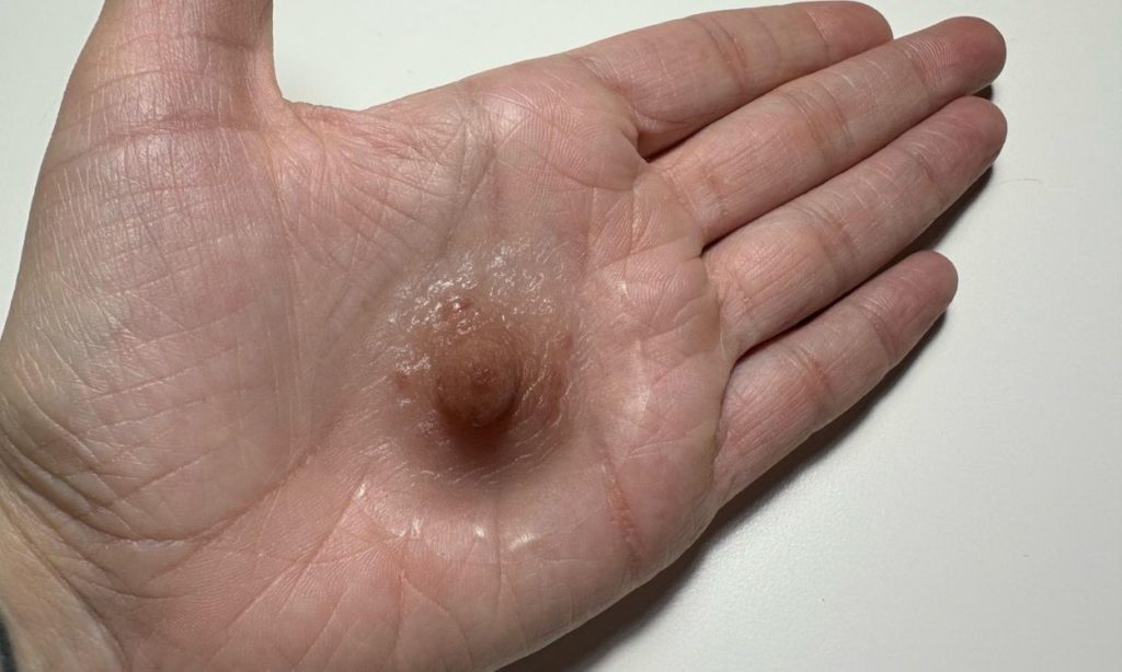 prótesis areola