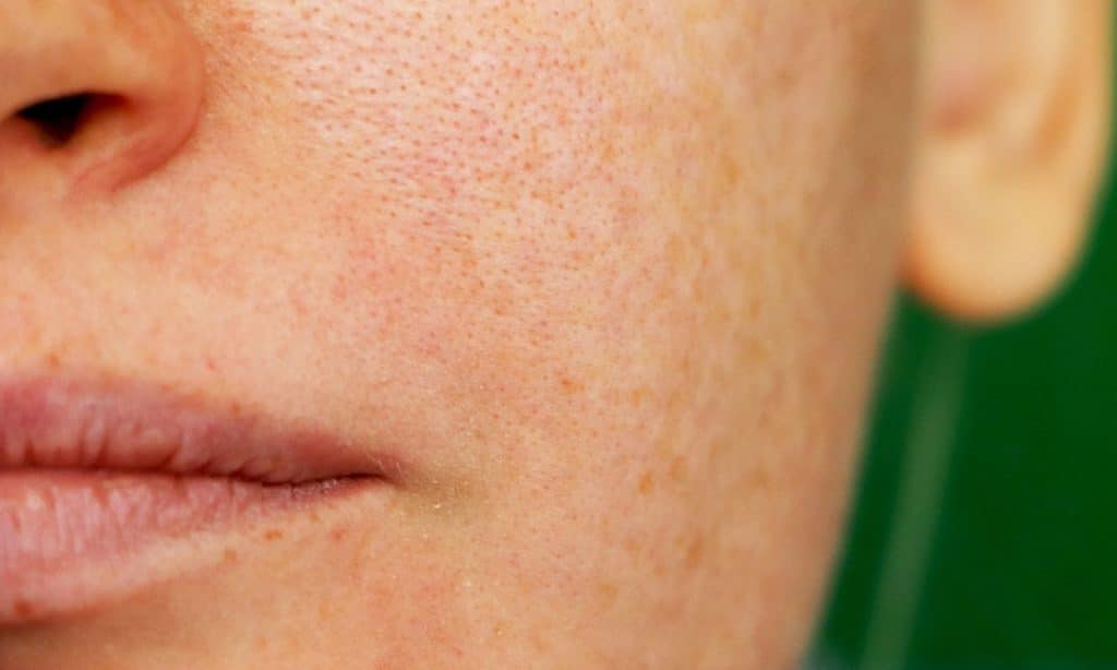 imagen-destacada-melasma-vs-manchas-solares
