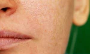 imagen-destacada-melasma-vs-manchas-solares